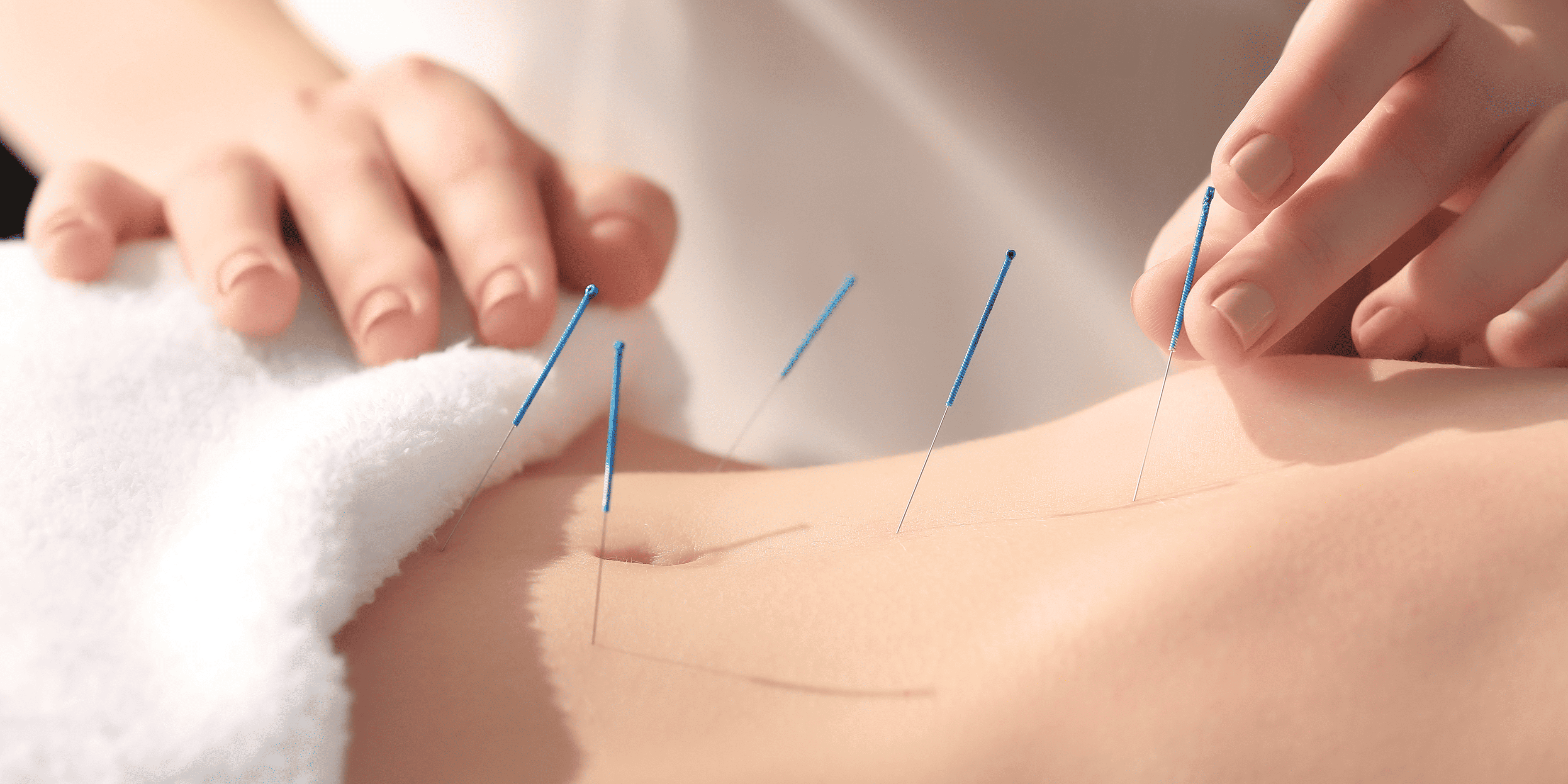 Acupuncture-Based Therapies